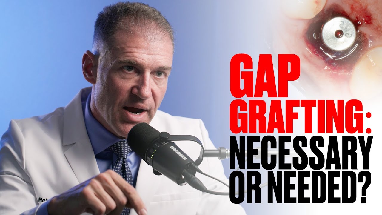 You don't HAVE to Gap Graft Dental Implants....But You SHOULD (and Here's Why!)