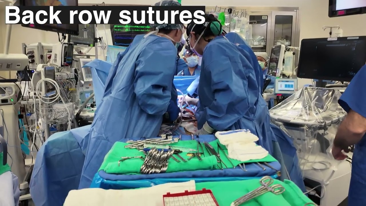 Как сделать открытую гепатикоеюностомию