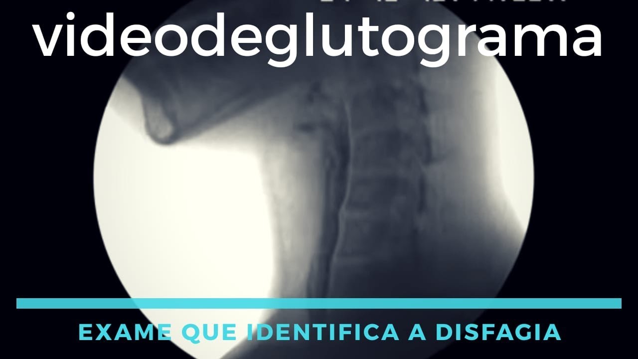 Vídeodeglutograma. Exame que identifica a disfagia