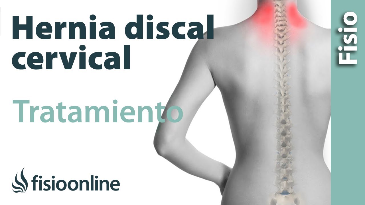 Hernia discal cervical - Tratamiento con ejercicios, automasajes y estiramientos