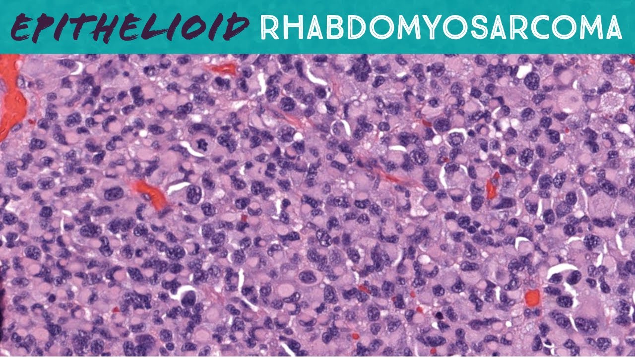 Epithelioid Rhabdomyosarcoma in Skin (Emory case 4) rhabdoid cytology dermpath pathology dermatology