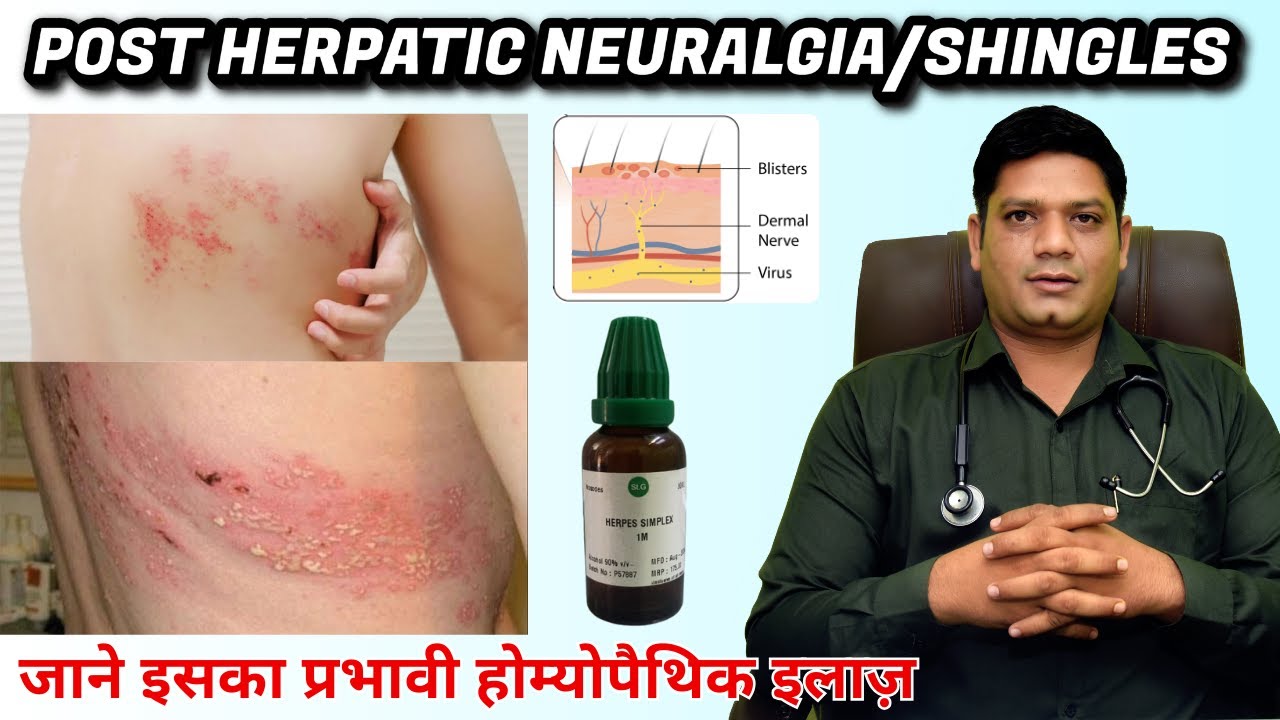 Postherpatic Neuralgia | Best Homeopathic Medicine for Shingles | Dr. Sunil Patidar #shingles