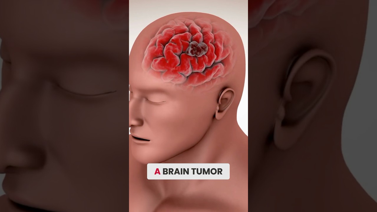 Focused Ultrasound Enhances Brain Tumor Treatment