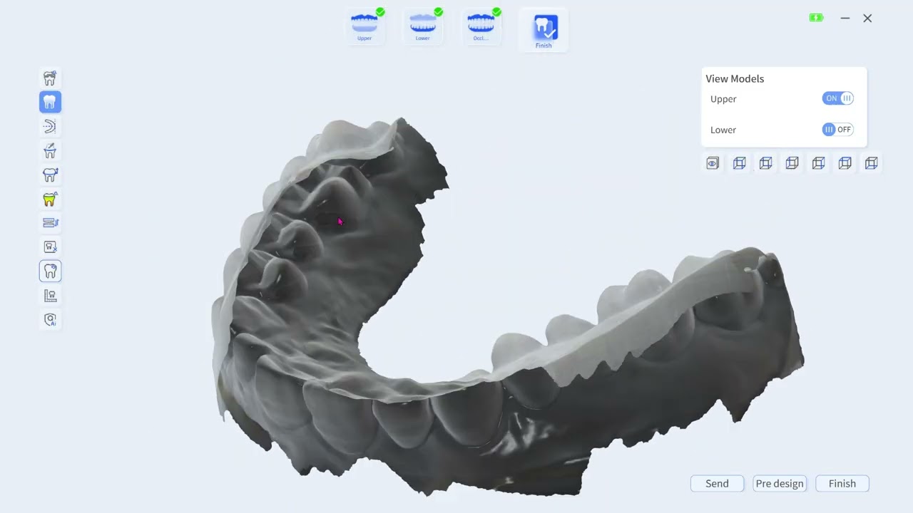 VLS100 Intraoral Scanner: A.I. Gap Filling