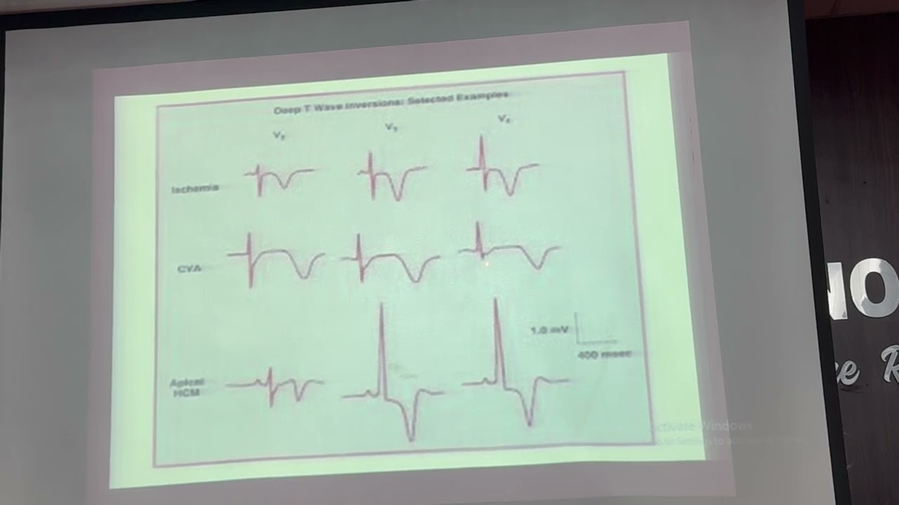 HOW TO APPROACH IN ACUTE CHEST PAIN