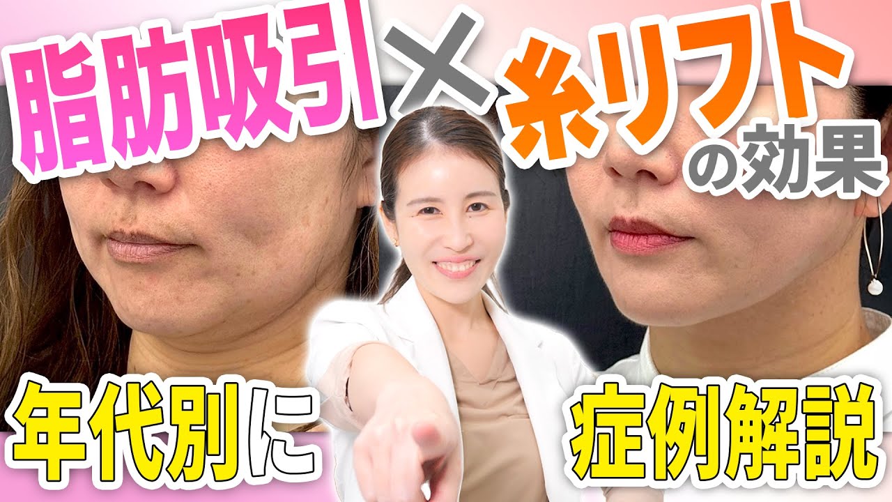 脂肪吸引×糸リフトの最強コンビ治療、1回で小顔に若返る方法を徹底解説