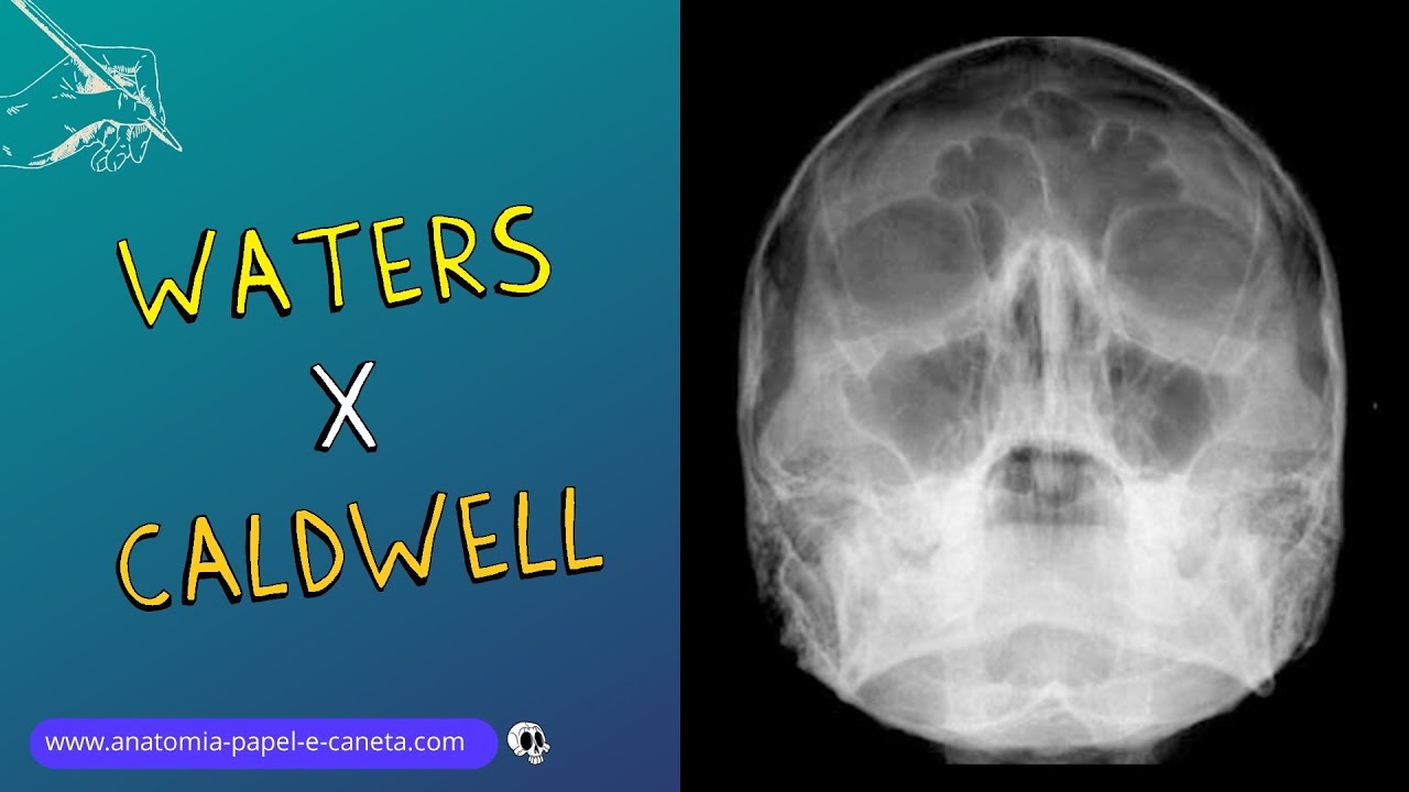 WATERS x CALDWELL - Sinusite no RX