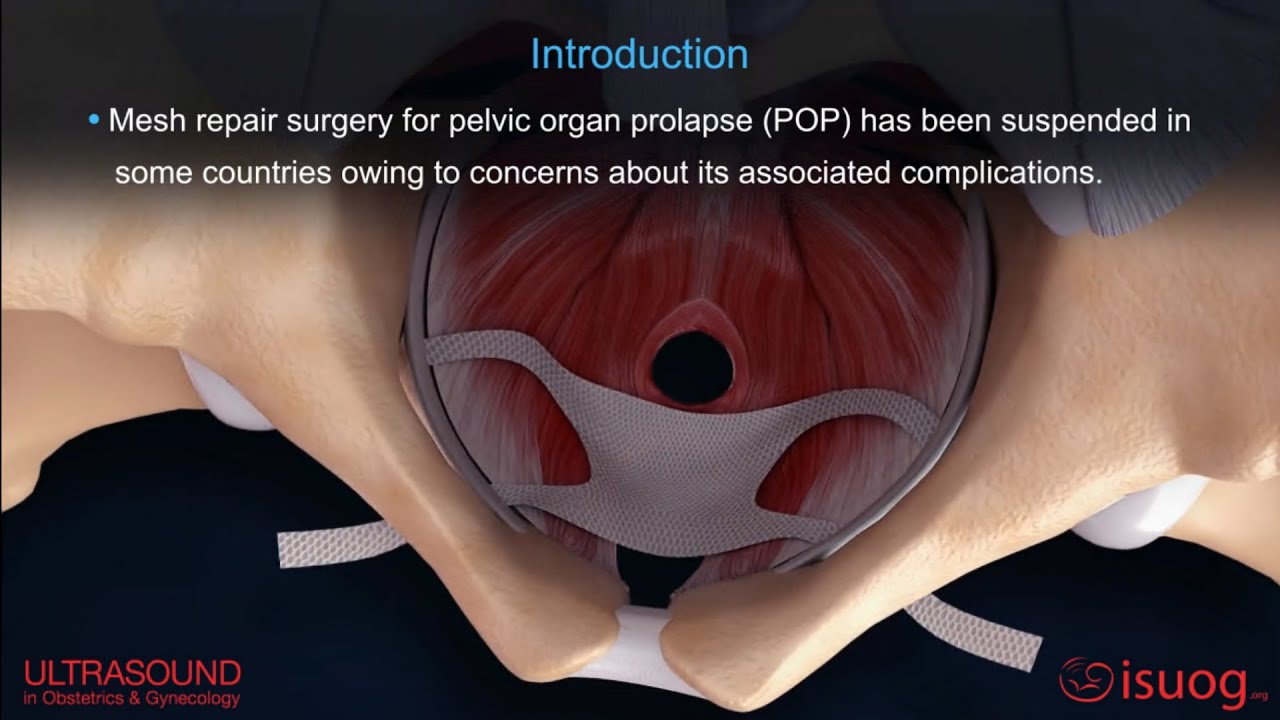 New #UOGJournal video abstract on the role of mesh surgery in management of women with prolapse