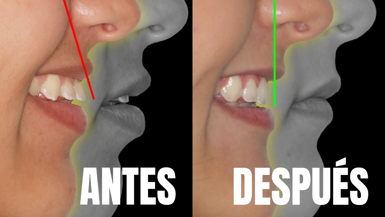 Mejoramos sus 👄 LABIOS SOBRESALIDOS con ORTODONCIA | Diagnostico y Tratamiento 🧐