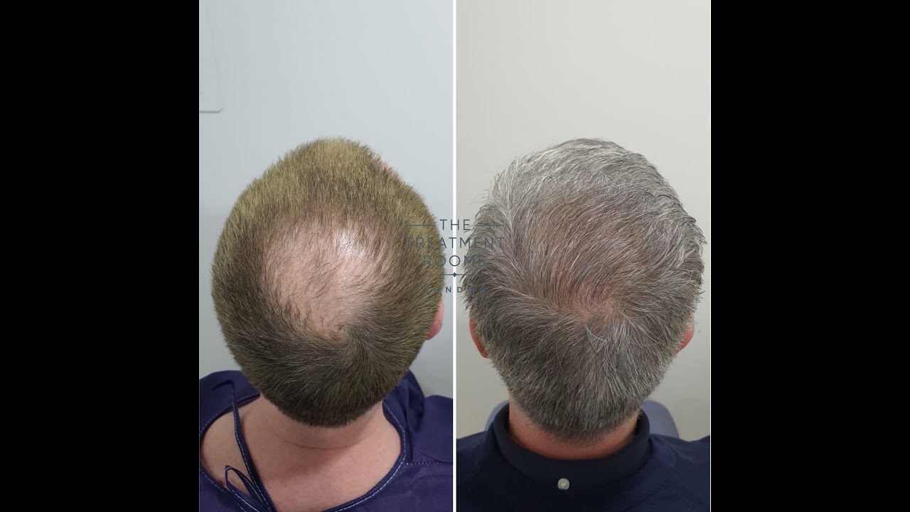 2322 Grafts FUE Hair Transplant Hairline and Crown