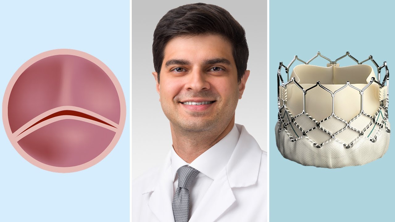 Bicuspid Aortic Valves: Surgical & Transcatheter Aortic Valve Replacement Options for Patients