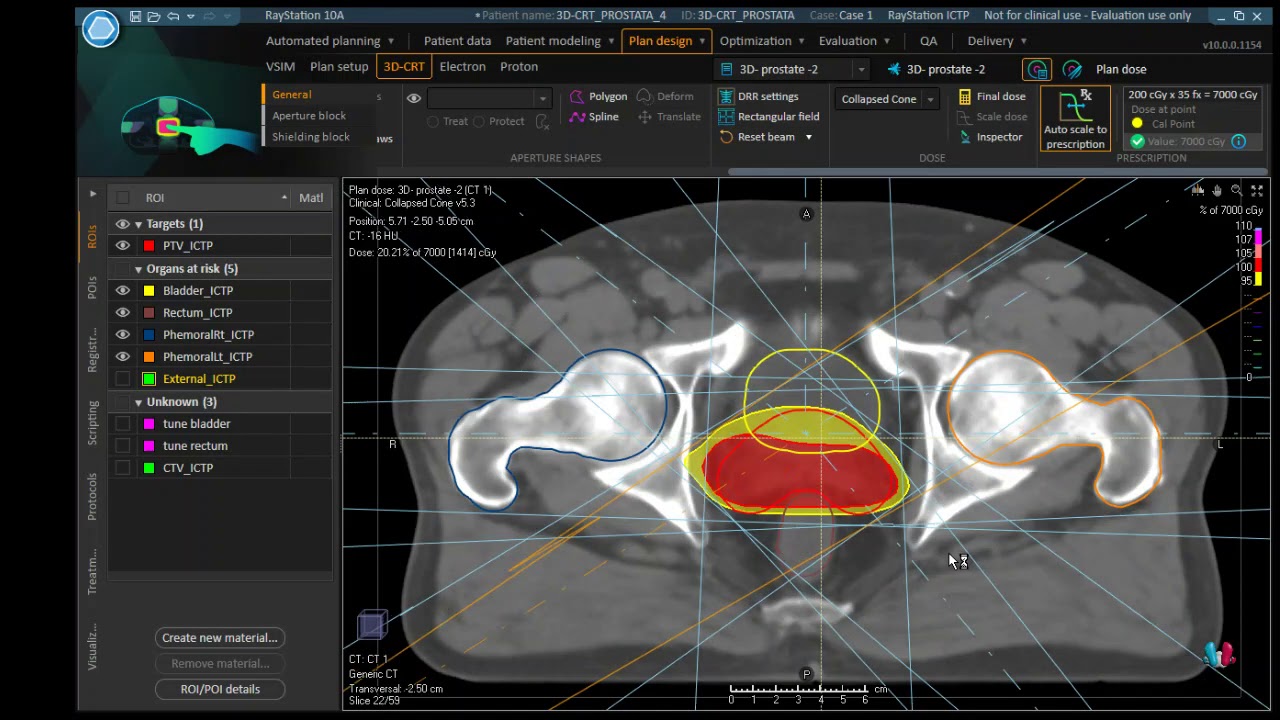 3D-prostate two plans in comparing using RayStation TPS