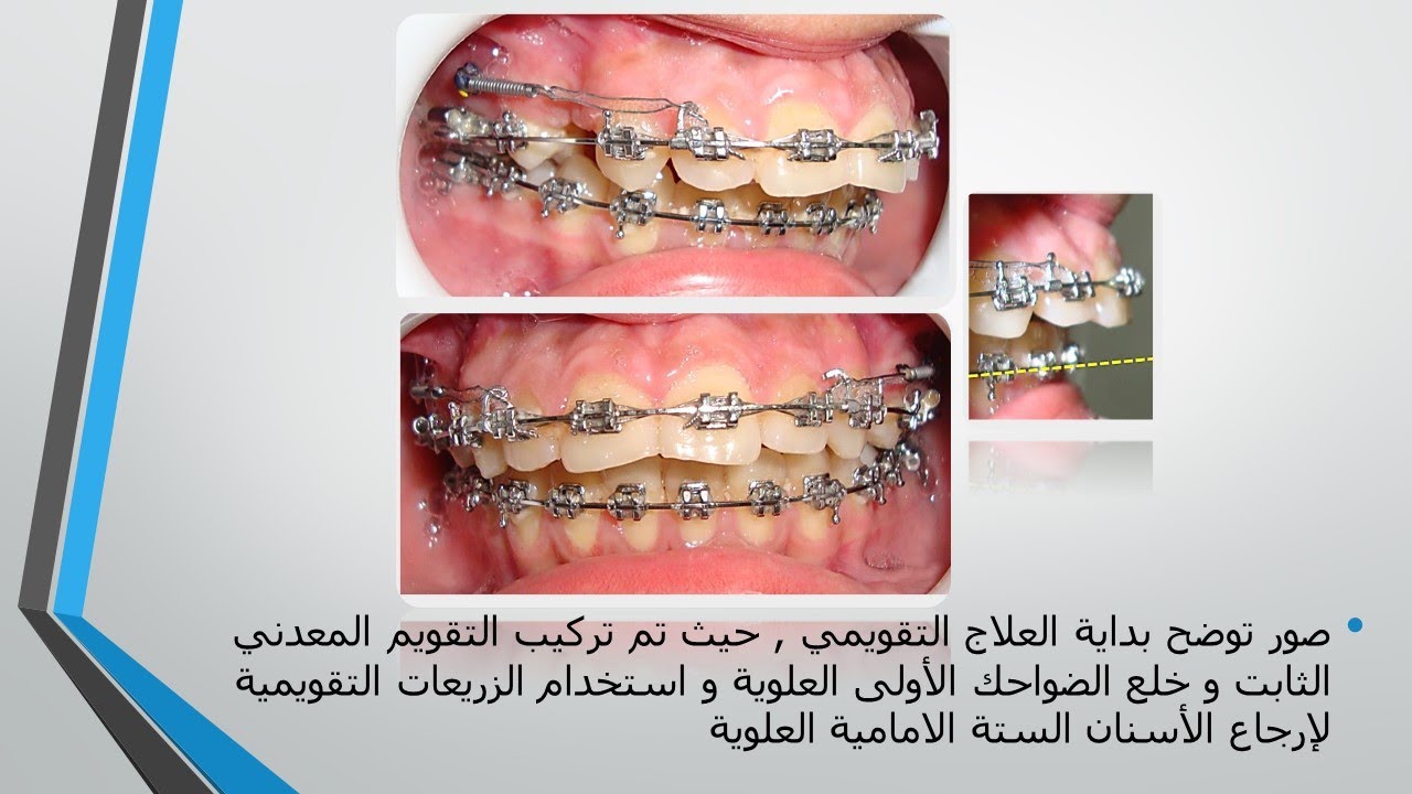 حالة سريرية لعلاج بروز الأسنان العلوية الشديد باستخدام التقويم الثابت مع الزريعات التقويمية
