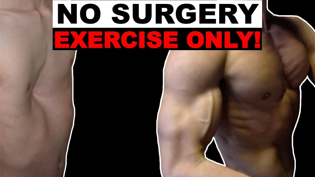 Pectus Excavatum Exercises (Fix it Without Surgery!)