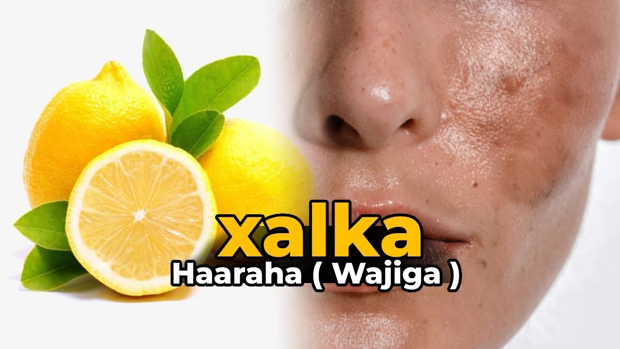 Haaraha Wajiga (Skin Spots): Sababaha, Daaweynta Dabiiciga ah & Talooyinka Ka Hortagga