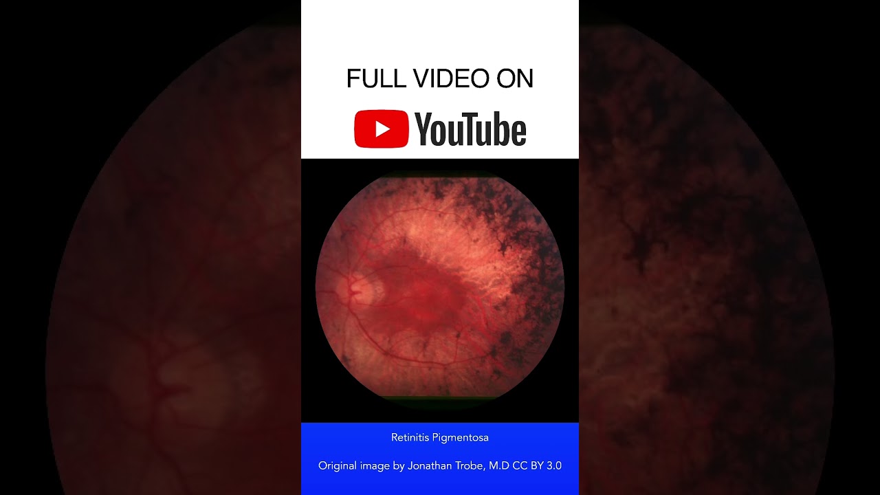 Retinitis Pigmentosa Fundoscopy