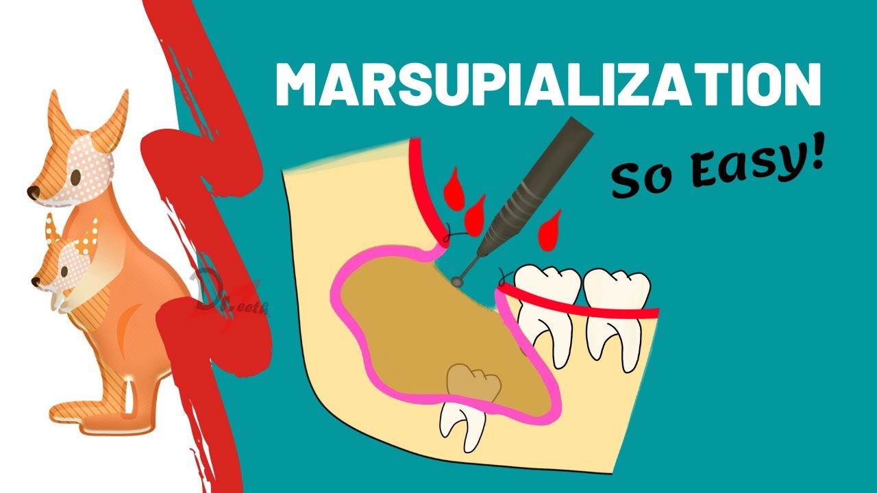 Марсупиализация | КОГДА, ПОЧЕМУ И КАК?