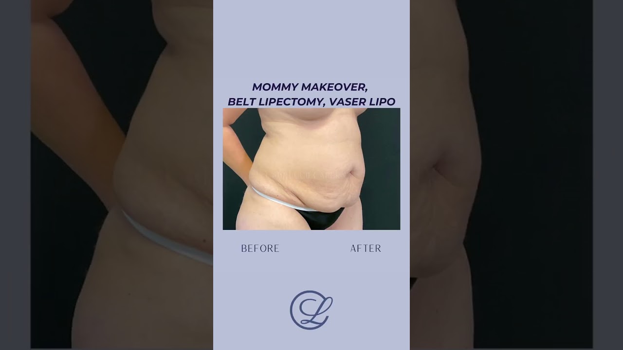 Mommy Makeover, Belt Lipectomy, VASER Lipo #liposuction #mommymakeover