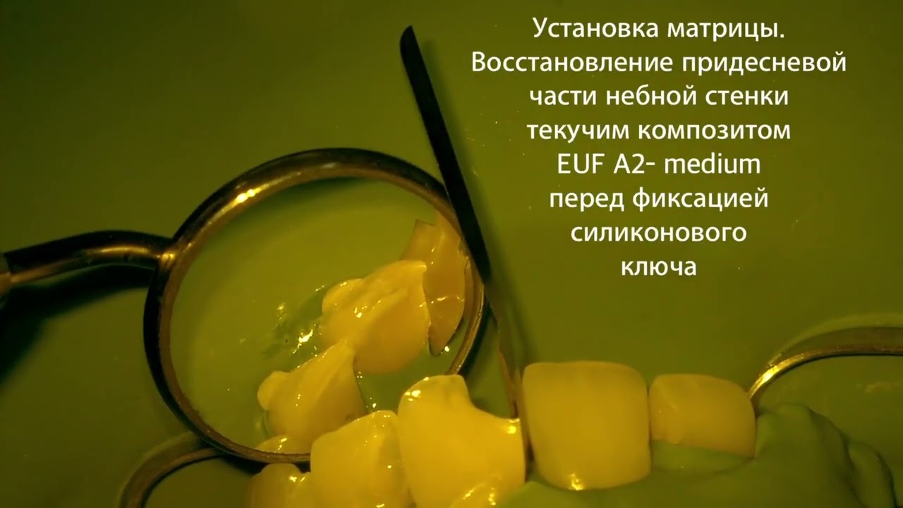 Клинический случай 4 класс с Omnichroma, Asteria, Blocker, EUF, Color. Врач &mdash; Мария Муравьева