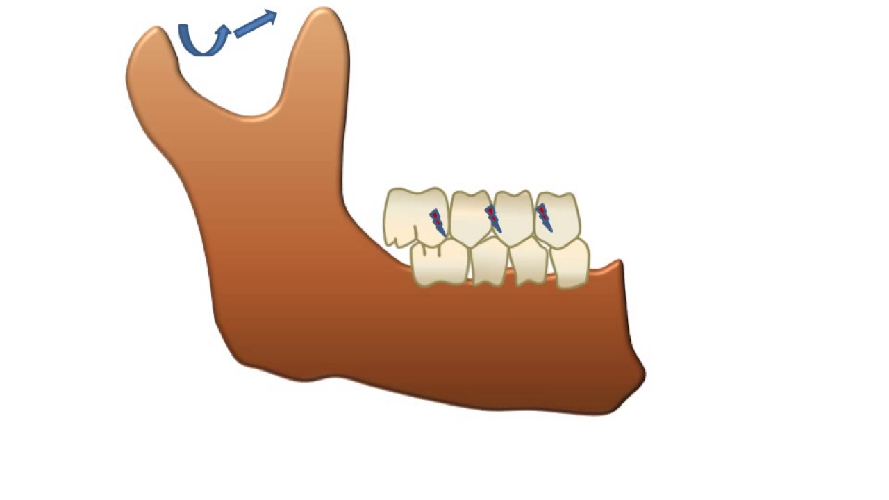 Introduction to equilibration - Occlusal interferences