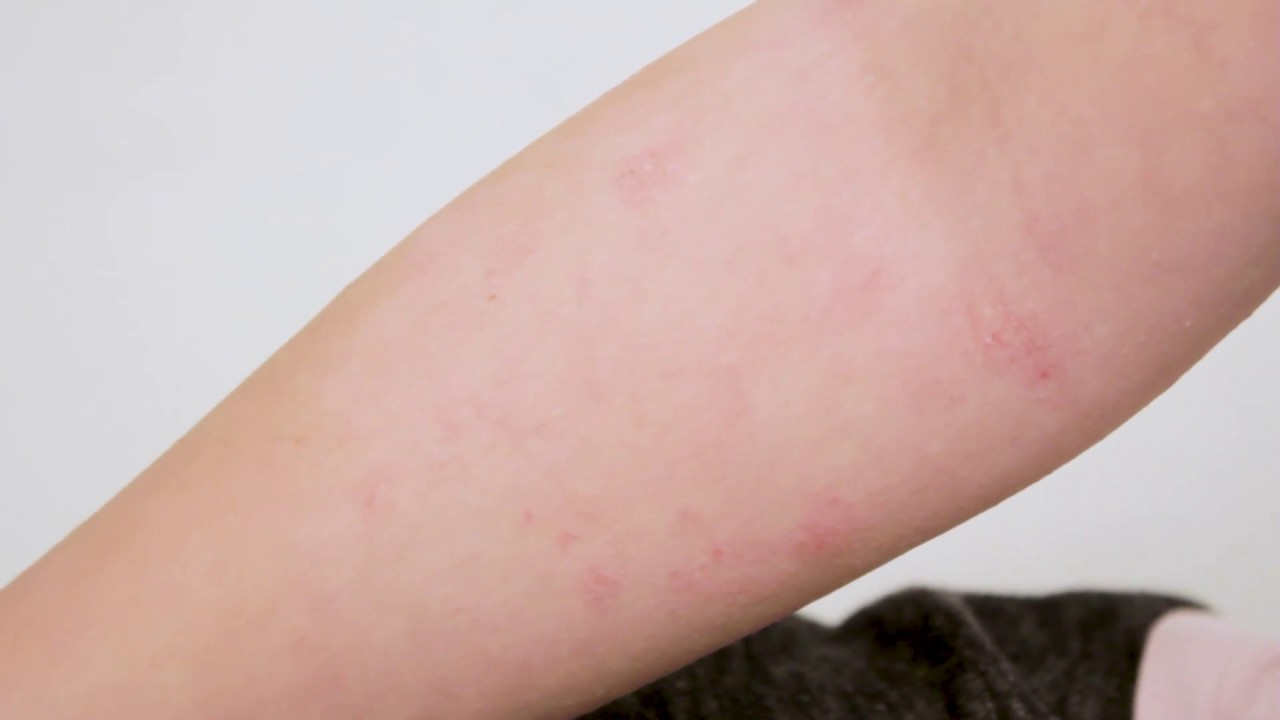 Atopijski Dermatitis