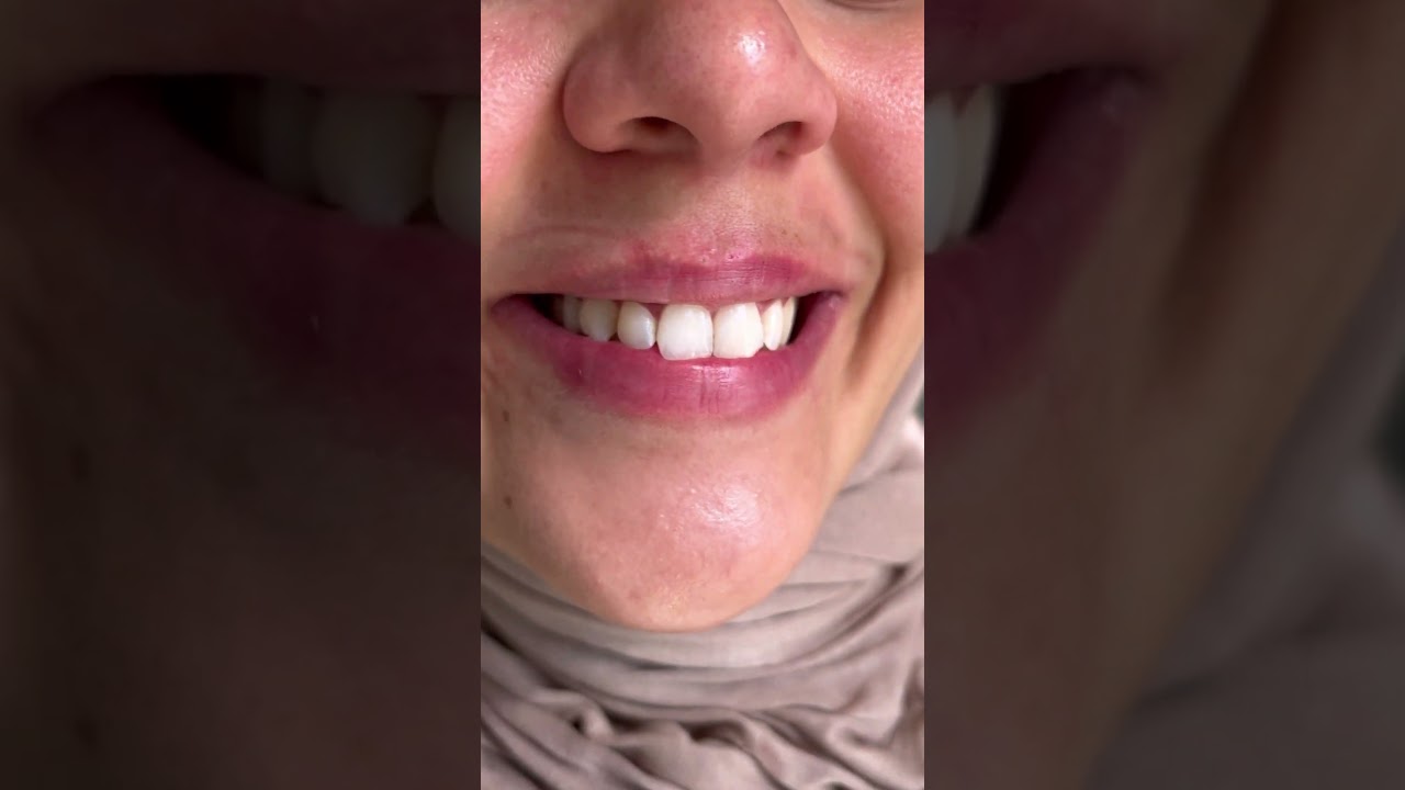 تبييض اسنان بعيادتي بالجزائر 🇩🇿 ولاية عنابة 0791724096