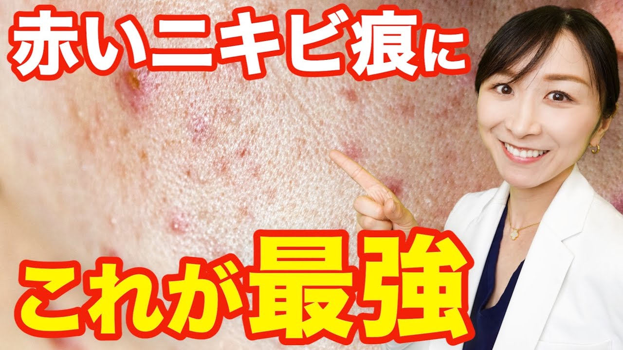 【これやってみて】赤いニキビ痕にはこの組み合わせがおすすめ！