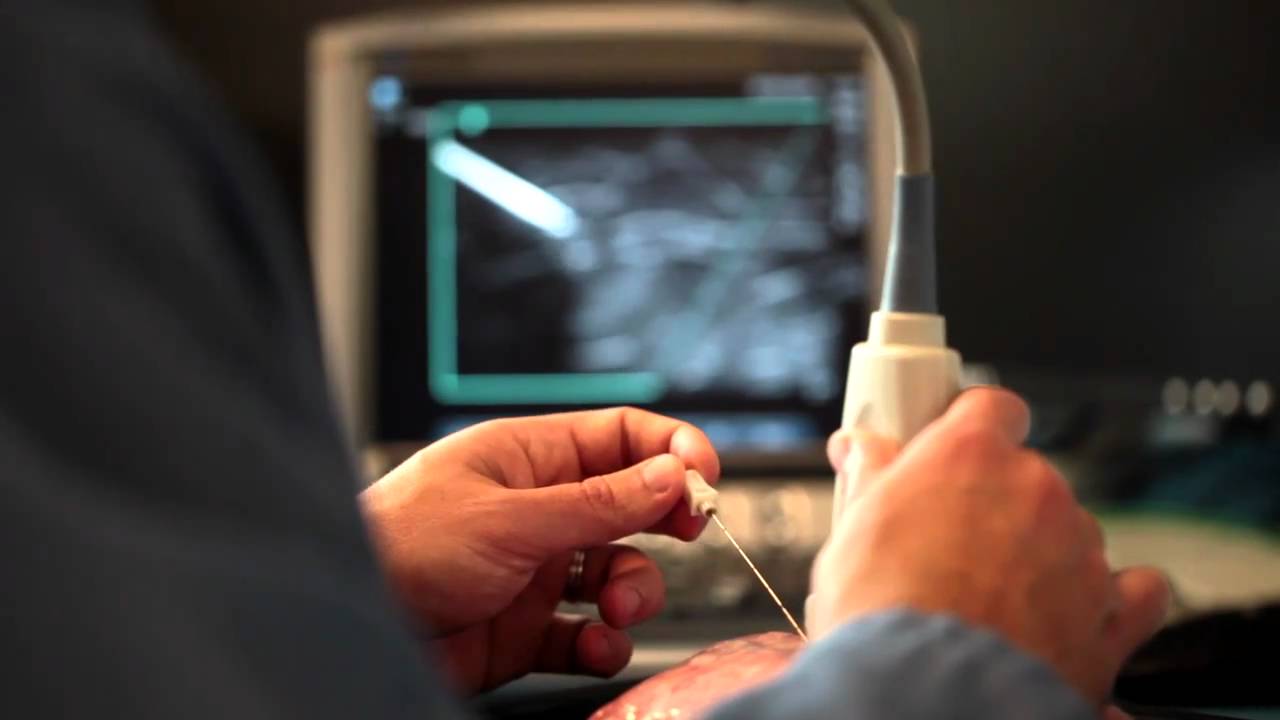 Advanced Needle Visualization for Primary Care - SonoSite Ultrasound