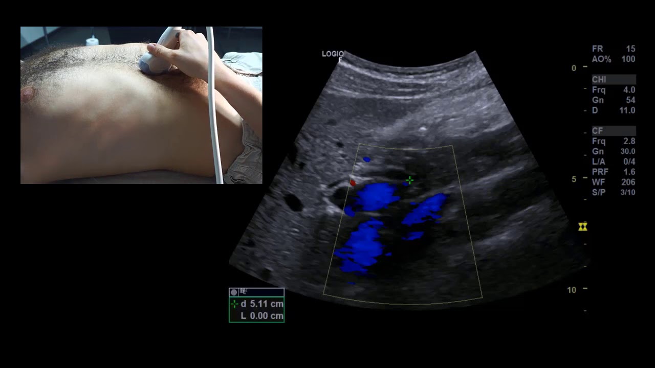 Sonographie der Leberpforte und Gallenblase