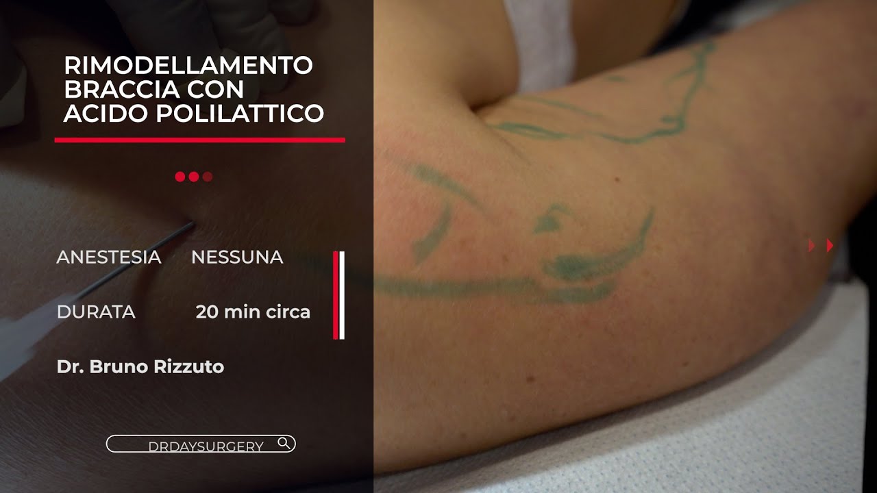 Acido Polilattico per Rassodare le Braccia: addio lassità cutanea!
