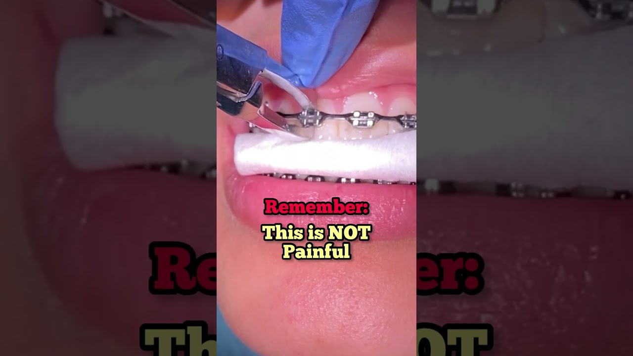 Брекеты: 2 года менее чем за 60 секунд &mdash; семейная стоматология Toothtime, Нью-Браунфелс