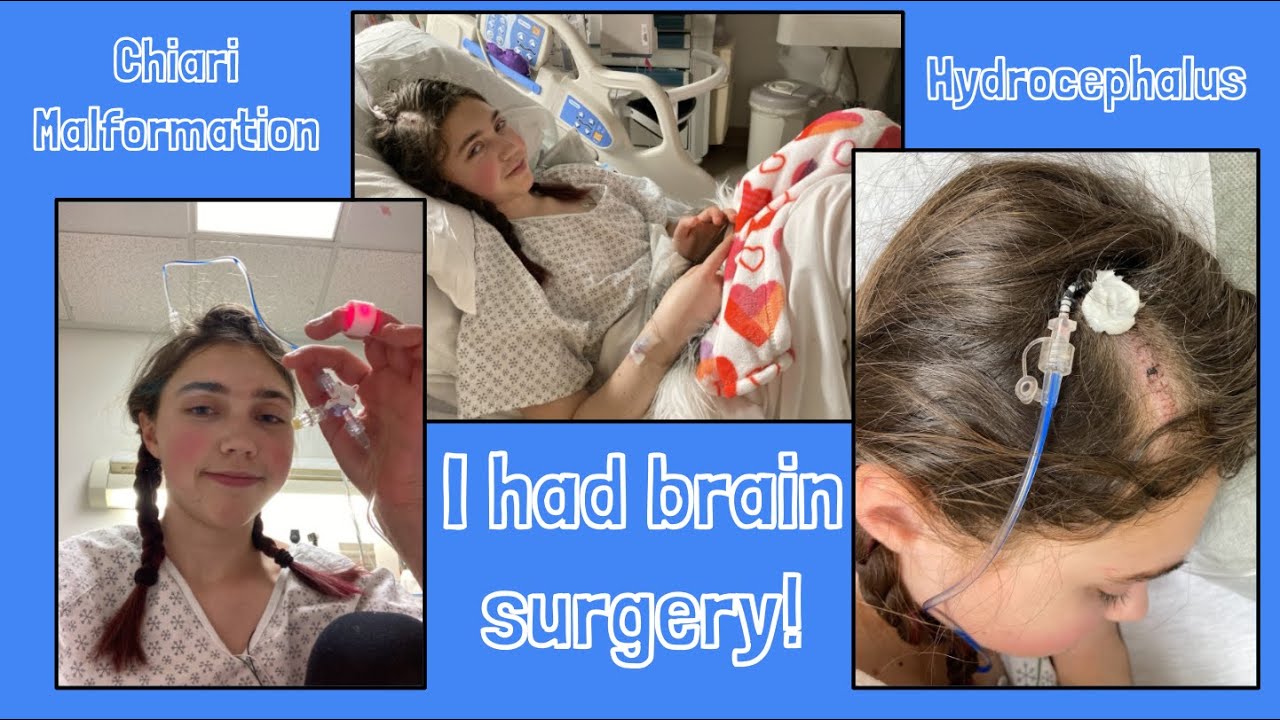 Chiari Decompression Surgery | Hydrocephalus | Complex Chiari 1.5 | My Chiari Story | Brain Surgery