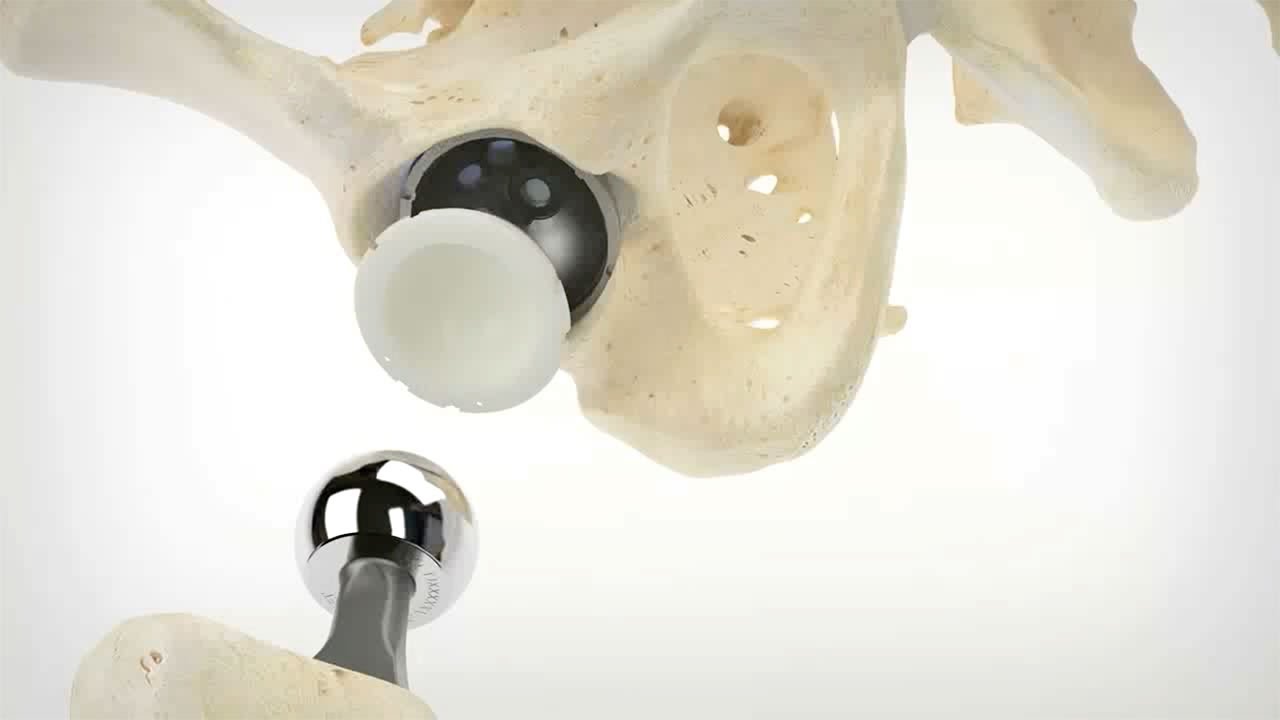 La technologie robotique MAKO® et le projet de récupération rapide après chirurgie (RRAC)