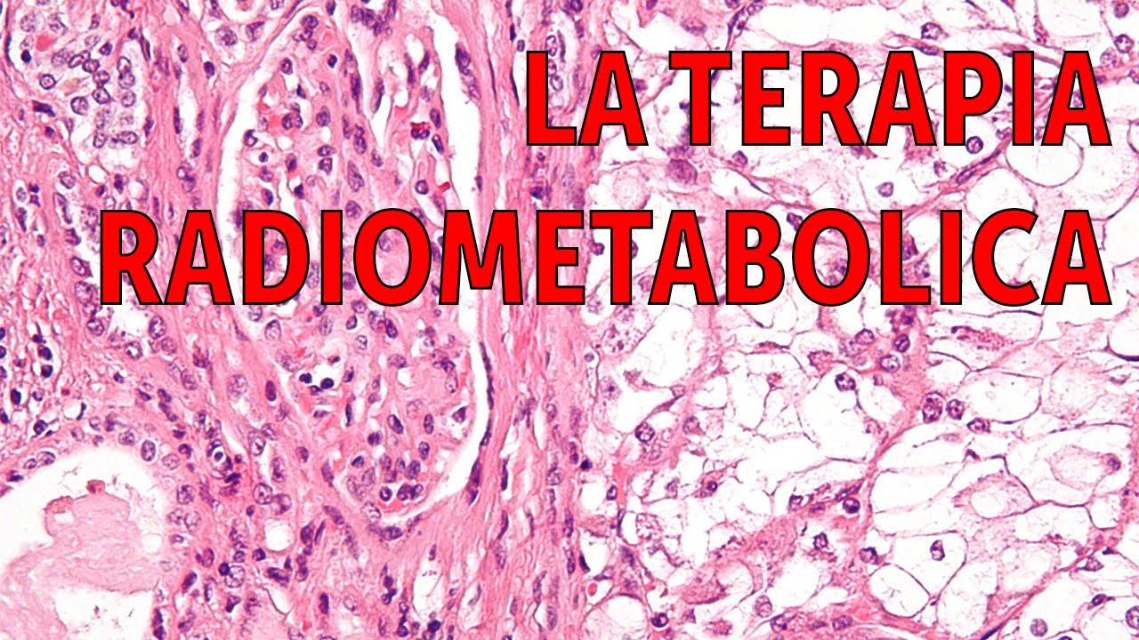 Isotopi Radioattivi per Radioterapia - Terapia Radiometabolica (feat. Irene)