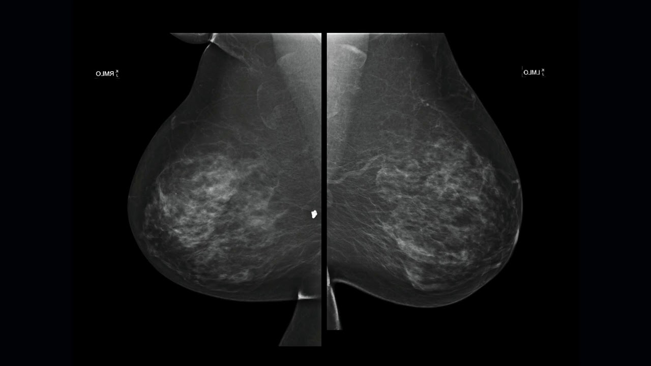 Breast Tomosynthesis:  Current State of the Art