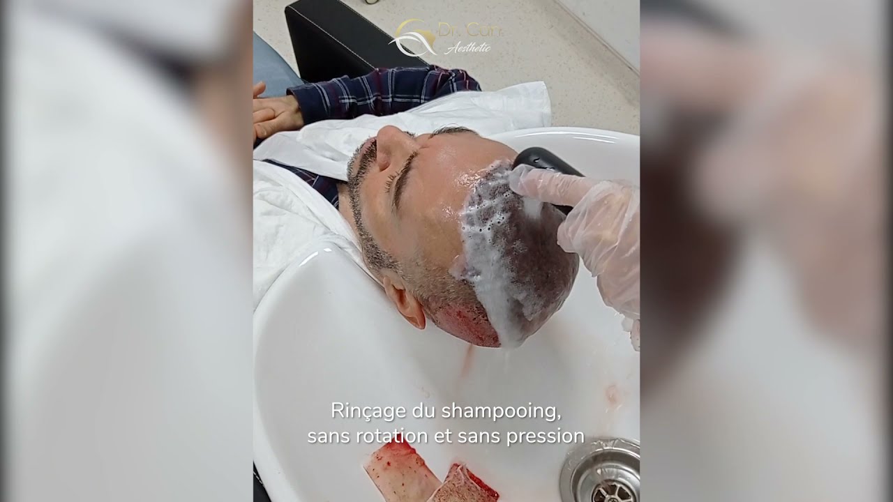 Guide de lavage postopératoire après la greffe de cheveux avec Dr. Can Aesthetic