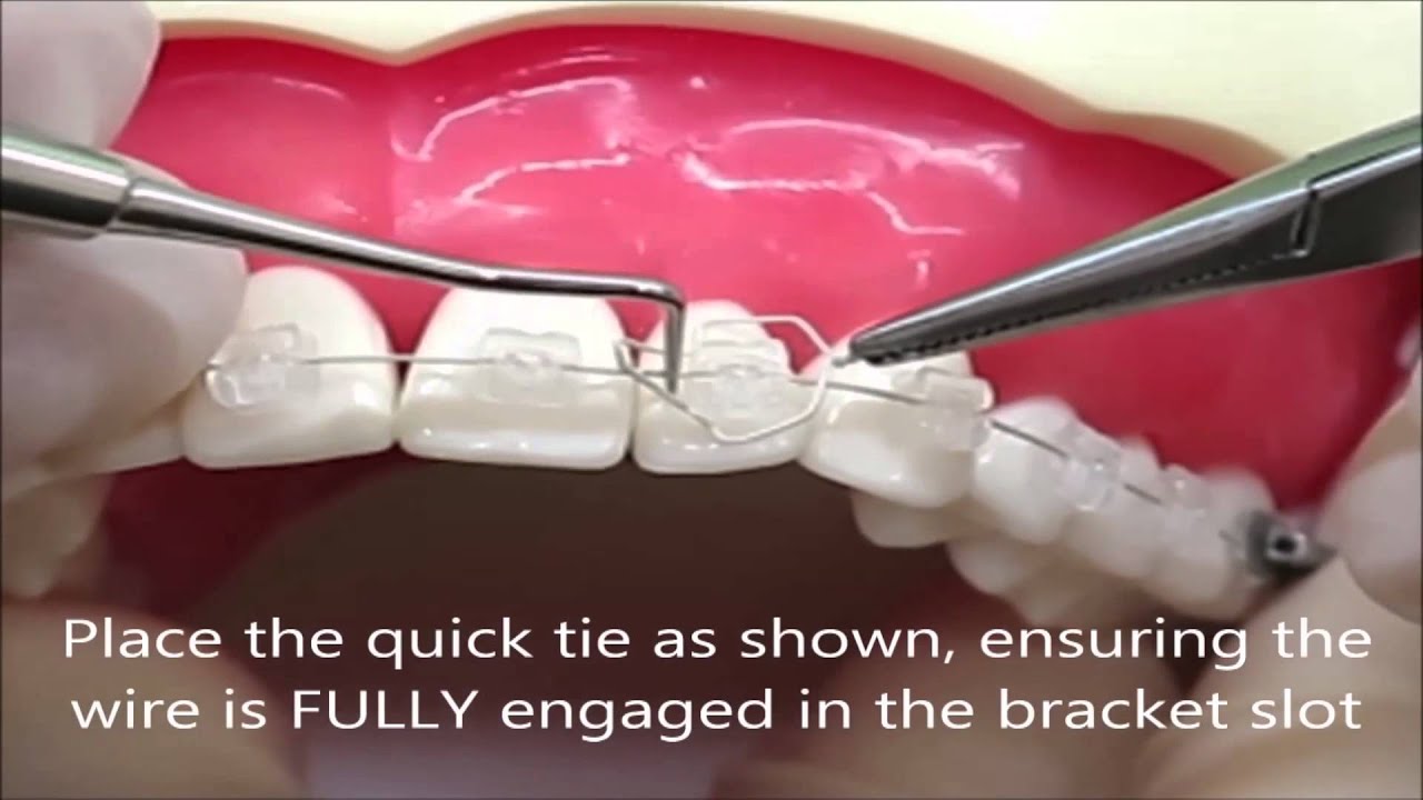 Quick Ties for rotated teeth