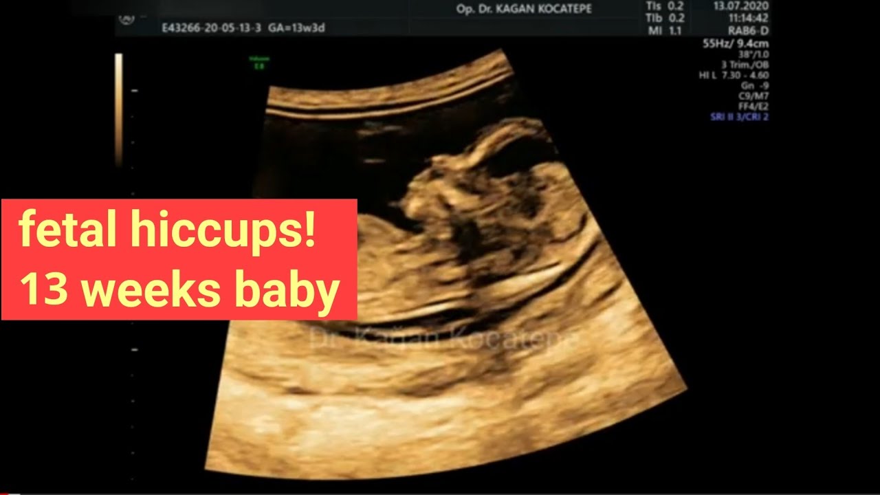 13 weeks (3 months) baby in the womb. Hiccups with whole body going up. Detailed ultrasound exam.