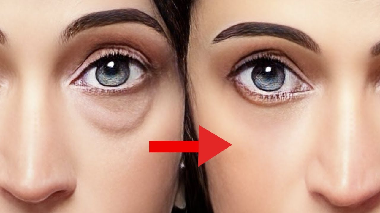 Remove Eye Bags, Dark Circles, Swelling Under Eyes Naturally. Get Amazing Result! Reverse your Age!