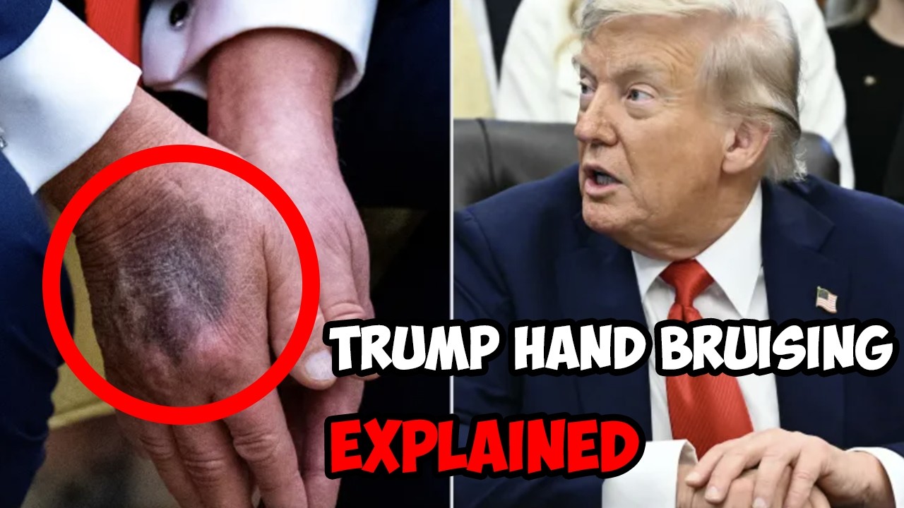 Trump Hand Bruising Explained: High dose Aspirin