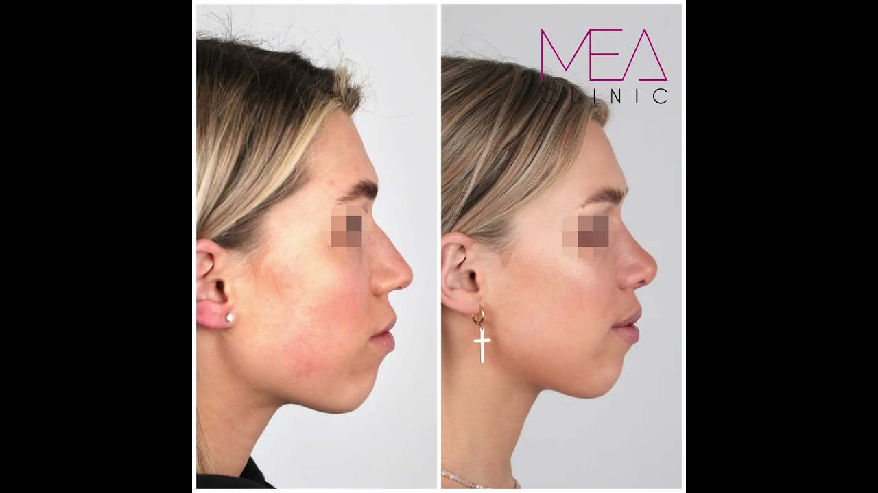 Operacja nosa - przed i po (Nose surgery - before & after)