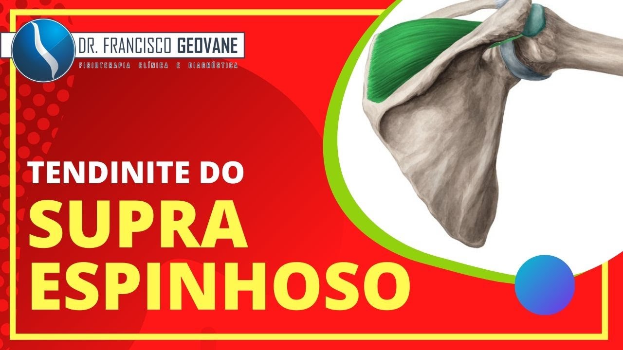 Dor no ombro, o que pode ser? Pode ser TENDINITE DO SUPRAESPINHOSO
