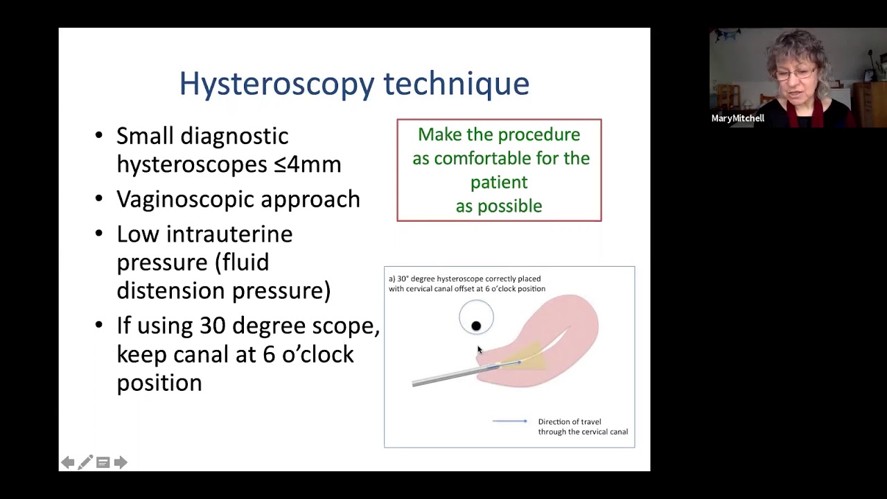 (ASPIRE Webinar) Office Hysteroscopy