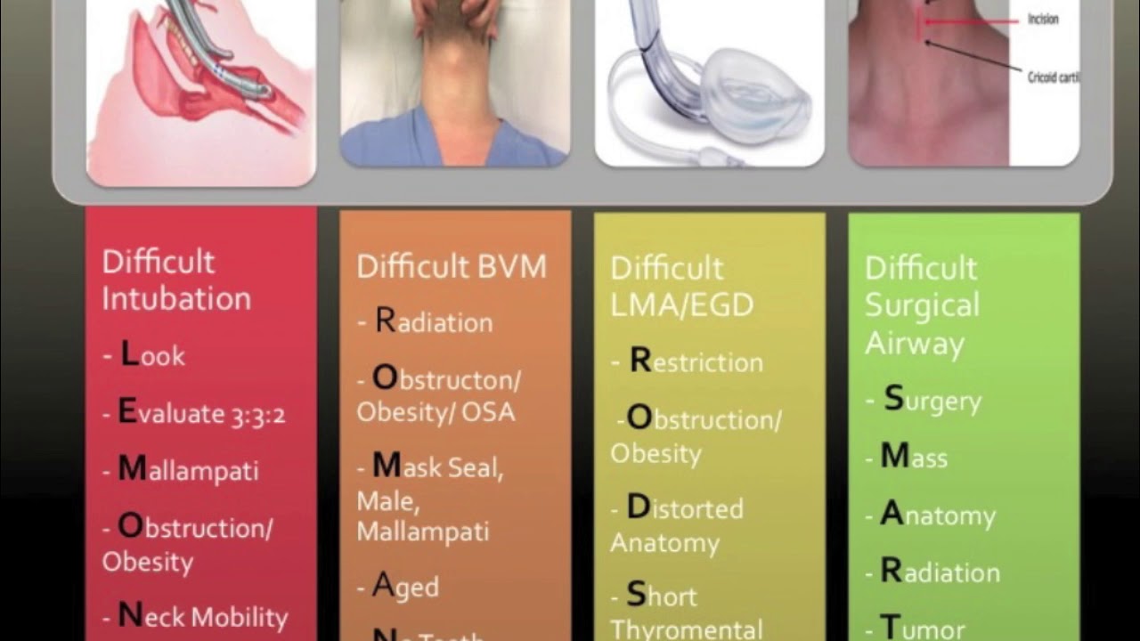 Pre Intubation Airway Assessment