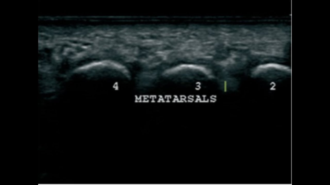 Ultrasound of the big toe