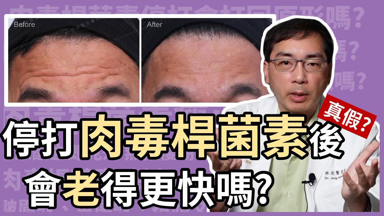 停打肉毒桿菌素，會老得更快嗎？打肉毒桿菌素除了除皺還可以提升膚質？就讓皮膚科林政賢醫師來分析給你聽！