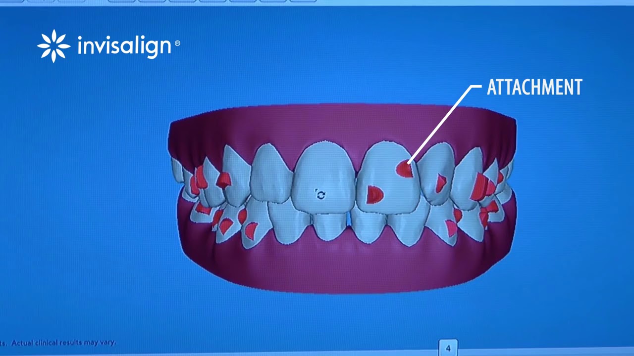 Invisible Braces technique for correcting irregular teeth..Latest Method.