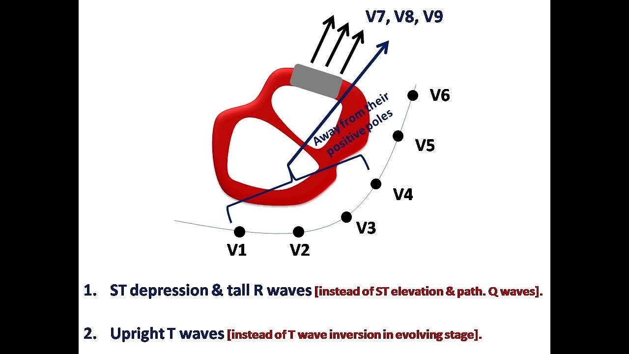 ECG course: Posterior MI, Dr. Sherif Altoukhy