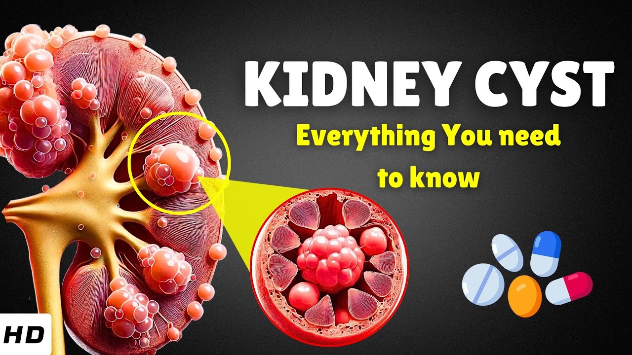 Kidney Cyst (Renal Cyst) &ndash; Causes, Signs and Symptoms, Diagnosis & Treatment