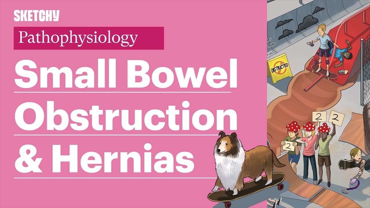 Small Bowel Obstruction (SBO), Ileus, & Hernia (Part 1) | Sketchy Medical  | USMLE Step 1.